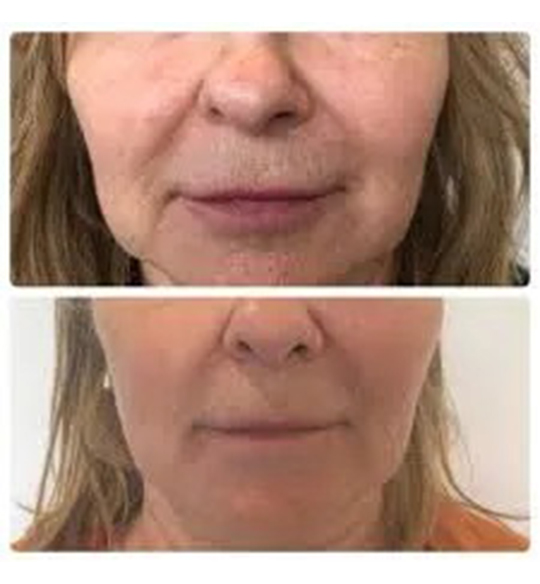 Results of using the Profhilo® Treatment