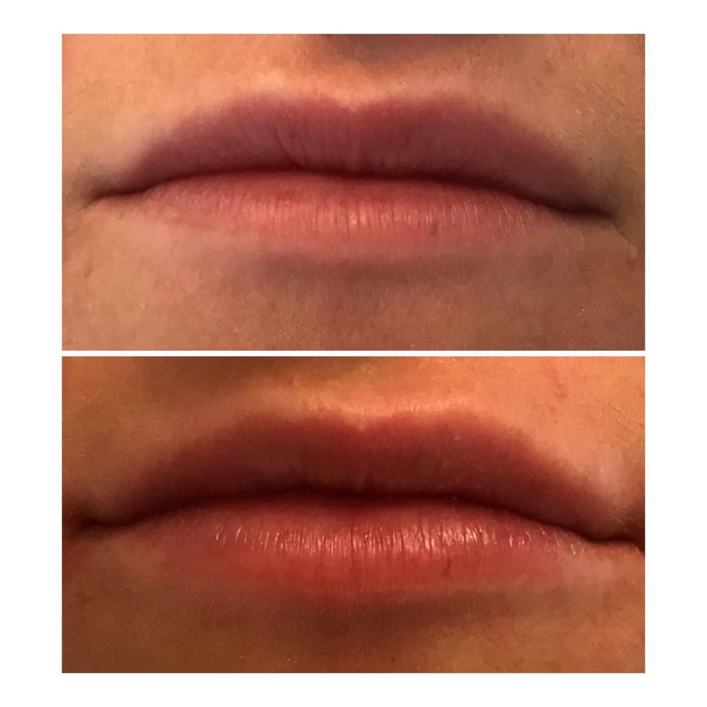 Natural looking lip filler treatments