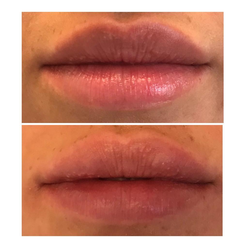 Lip filler treatment