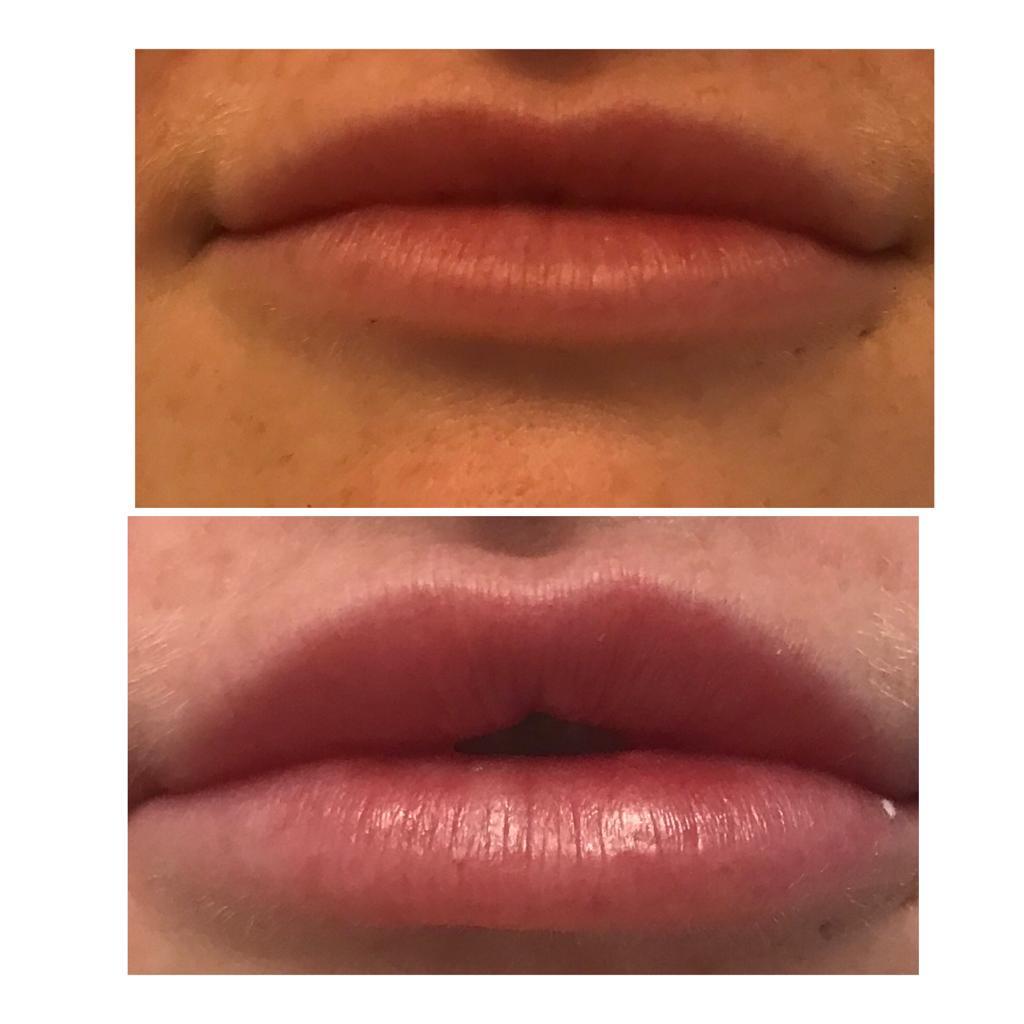 Lip filler treatment results