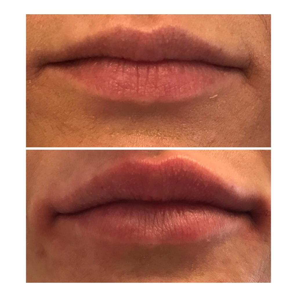 Lip filler treatment results