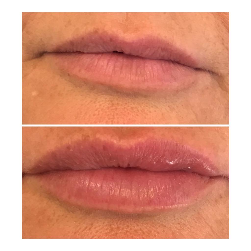 Natural looking lip filler