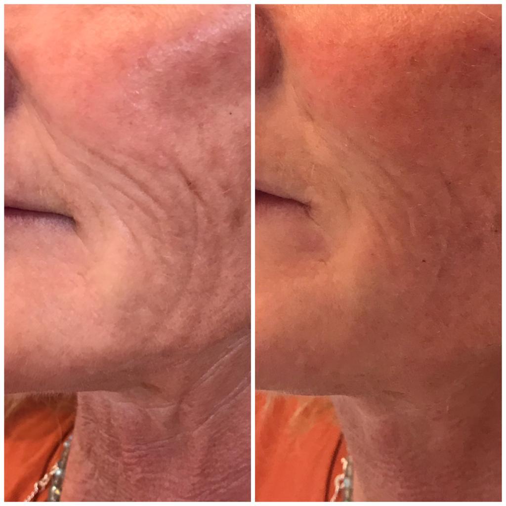 Results from a dermal filler treatment