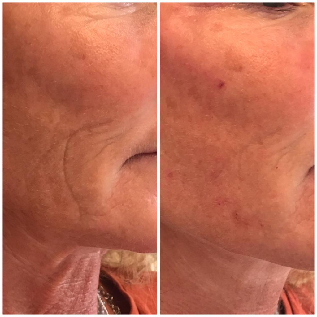 Dermal filler treatment results