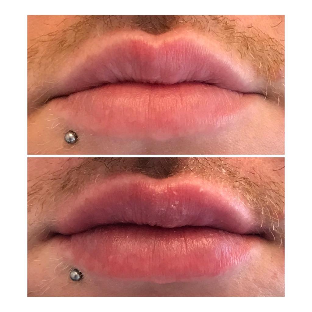 Lip filler treatment results