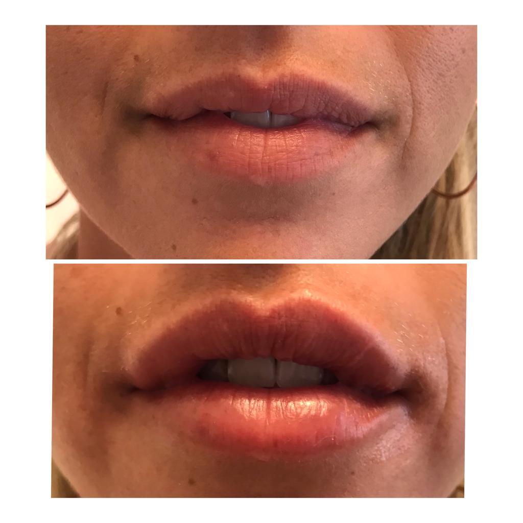 Lip filler treatment