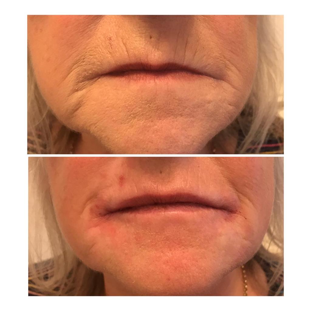 Lip filler results