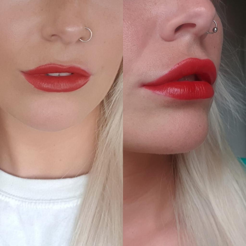 Lip filler treatment results