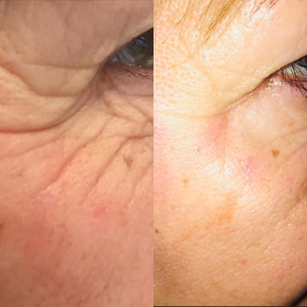 Results of a BOTOX® treatment