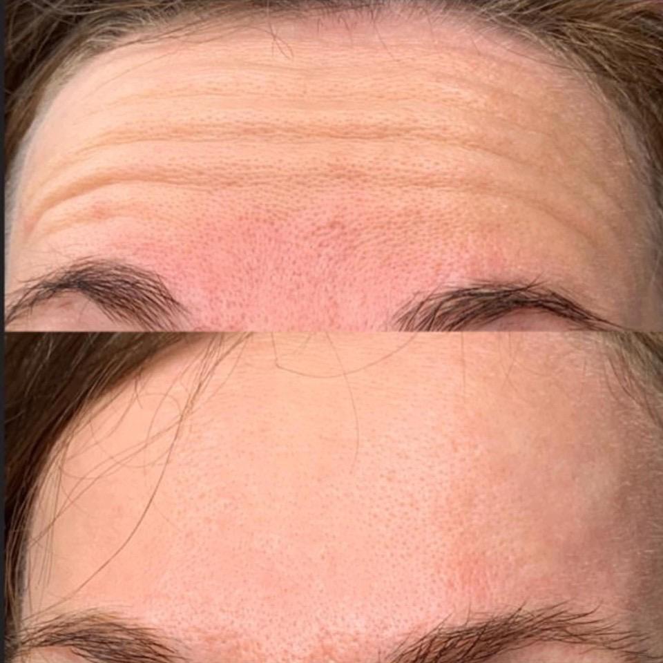 Results of a BOTOX® treatment