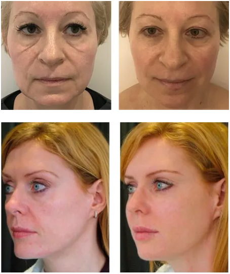 Dermal Fillers Fight Away Facial Wrinkles And Lines