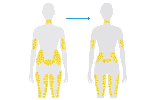 Coolsculpting removes fat cells