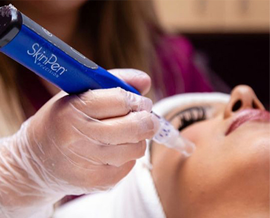 Skin pen microneedling treatments